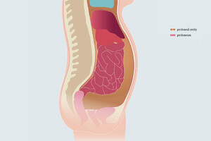 Ascites Drainage