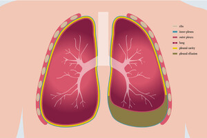 Pleural Drainage