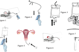 Postpartum Balloon Catheter